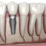 ایمپلنت دندان،راه‌حلی دائمی برای بازسازی دندان‌های از دست رفته