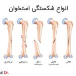 کمک‌های اولیه ۱: شکستگی استخوان