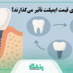 قیمت ایمپلنت دندان در سال 1404 + جدول هزینه انواع برندها【سال1404】