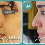 بهترین دکتر فیلر بینی در تهران + لیست 10 دکتر برتر