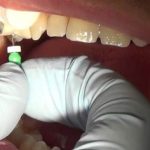 آیا ممکن است عفونت ریشه دندان پس از عصب‌کشی برگردد؟
