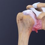اهمیت بررسی ابتلا به بیماری های زمینه ای در سندروم شانه یخ زده