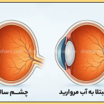 اگر آب مروارید را جدی نگیرید، ممکن است بینایی خود را برای همیشه از دست بدهید