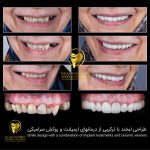 ایمپلنت فوری یک روزه چیست؟ آیا میتوان ایمپلنت را یک روزه به انجام رساند؟