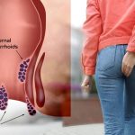 لیزر بواسیر؛ راهکار پایان دردهای همیشگی در بیماری های نشیمنگاهی