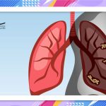 دلایل ابتلا به سرطان ریه در افراد غیرسیگاری