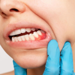 بررسی جامع، روش‌ها، کاربردها و نتایج بالینی جراحی کاهش پاکت پریودنتال