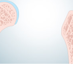 ارتباط افسردگی و پوکی استخوان؛ رابطه‌ای پنهان اما تاثیرگذار