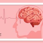 سکته مغزی دومین عامل مرگ‌ومیر در جهان؛ ۸۰ درصد سکته‌ها قابل پیشگیری است