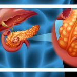 شناسایی علامت هشدار دهنده اولیه سرطان پانکراس، معروف به «قاتل خاموش