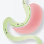 اسلیو معده؛ راهی مدرن برای کاهش وزن پایدار و زندگی سالم تر