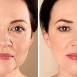 پروفایلو چیست؟عوارض،تزریق و ماندگاری