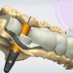 مقایسه ایمپلنت دیجیتال و سنتی در تبریز؛ کدام روش برای شما بهتر است؟