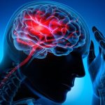 سن سکته مغزی در ایران ۱۰ سال کمتر از دنیاست!