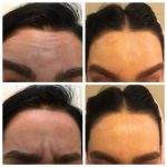 ۸ توصیه برای بوتاکس اولی‌ها که باید بدانید