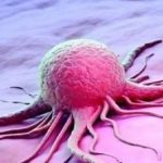 علائم هشداردهنده سرطان معده+ اینفوگرافی