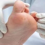 از چالش ها تا راهکارهای درمانی زخم پای دیابتی