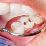 چرا دندان‌هایمان تند تند پوسیده می‌شوند؟