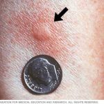 تست های آلرژی پوستی