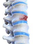 شکستگی‌های فشاری مهره‌ها و راه های درمان آن