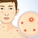 درمان و مراقبت‌های خانگی آبله‌مرغان