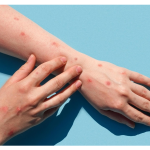 آبله مرغان چیست ؟