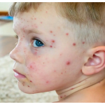 شناخت، پیشگیری و درمان آبله‌مرغان در کودکان