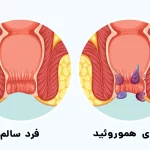 بررسی انواع مختلف بیماری های نشیمنگاهی + پیشگیری