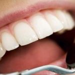 جرم‌گیری دندان ضرر دارد؟